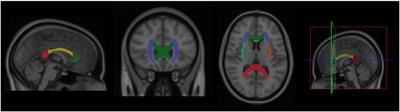 Effects of exercise types on white matter microstructure in late midlife adults: Preliminary results from a diffusion tensor imaging study